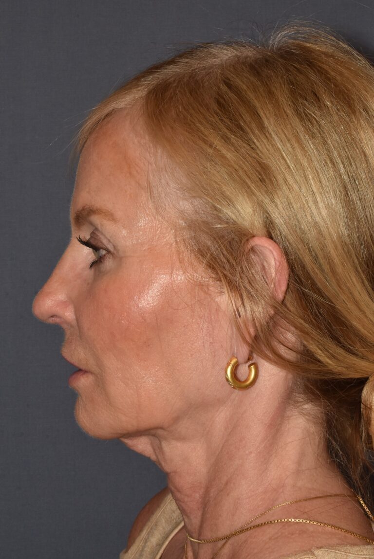 After Image: Rhinoplasty – Open - left-side