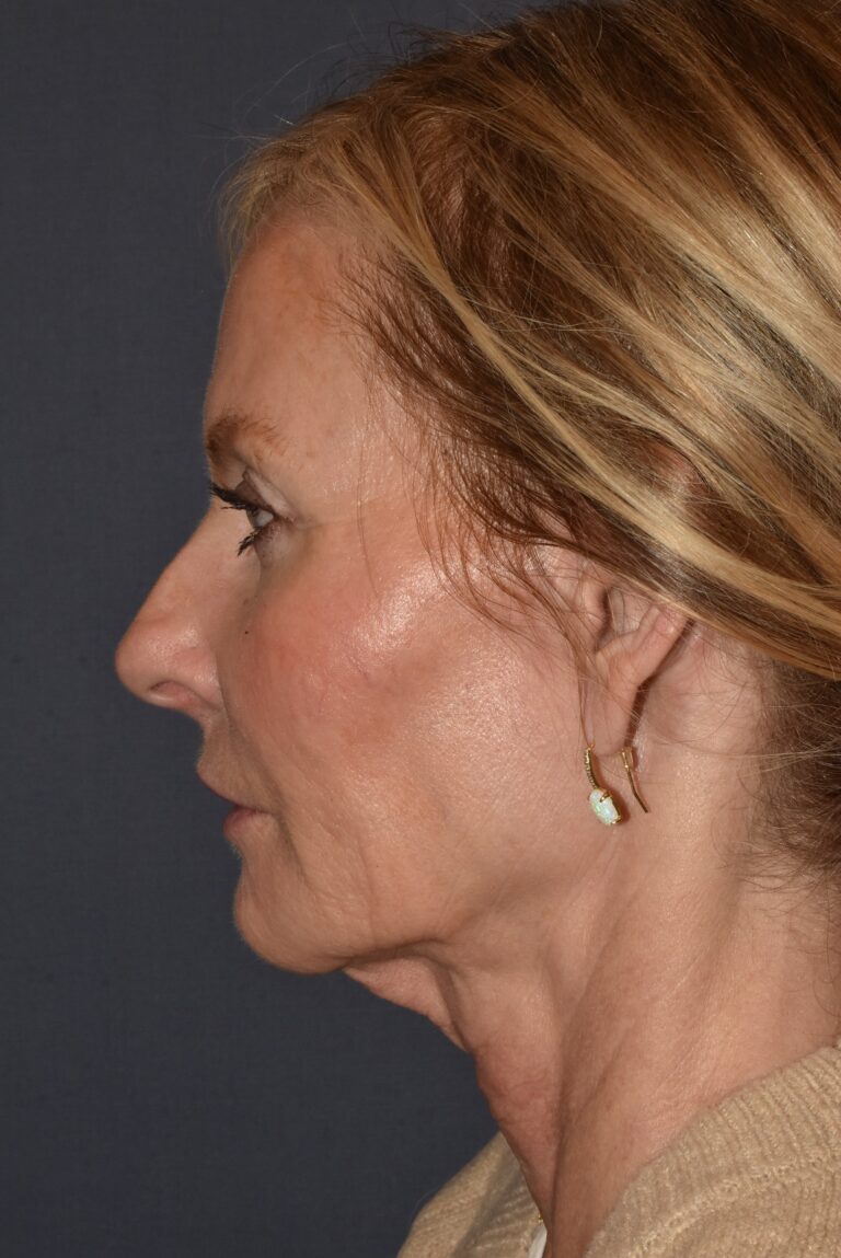 Before Image: Rhinoplasty – Open - left-side