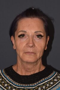 After Image: Facial Rejuvenation – Lower Facelift / Neck Lift with Chin Implant and Modified Brow Lift