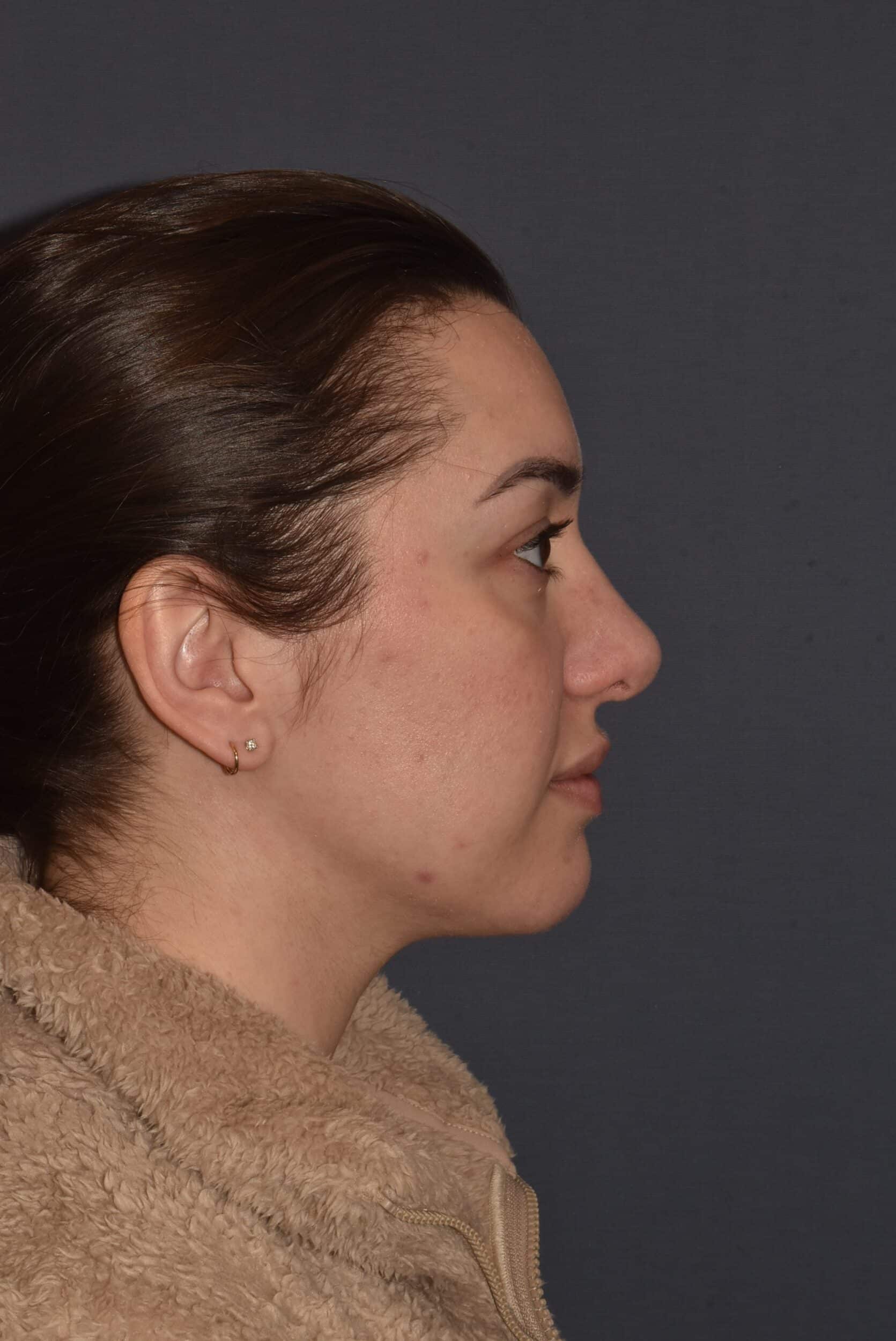 After Image: Rhinoplasty – Open - right-side