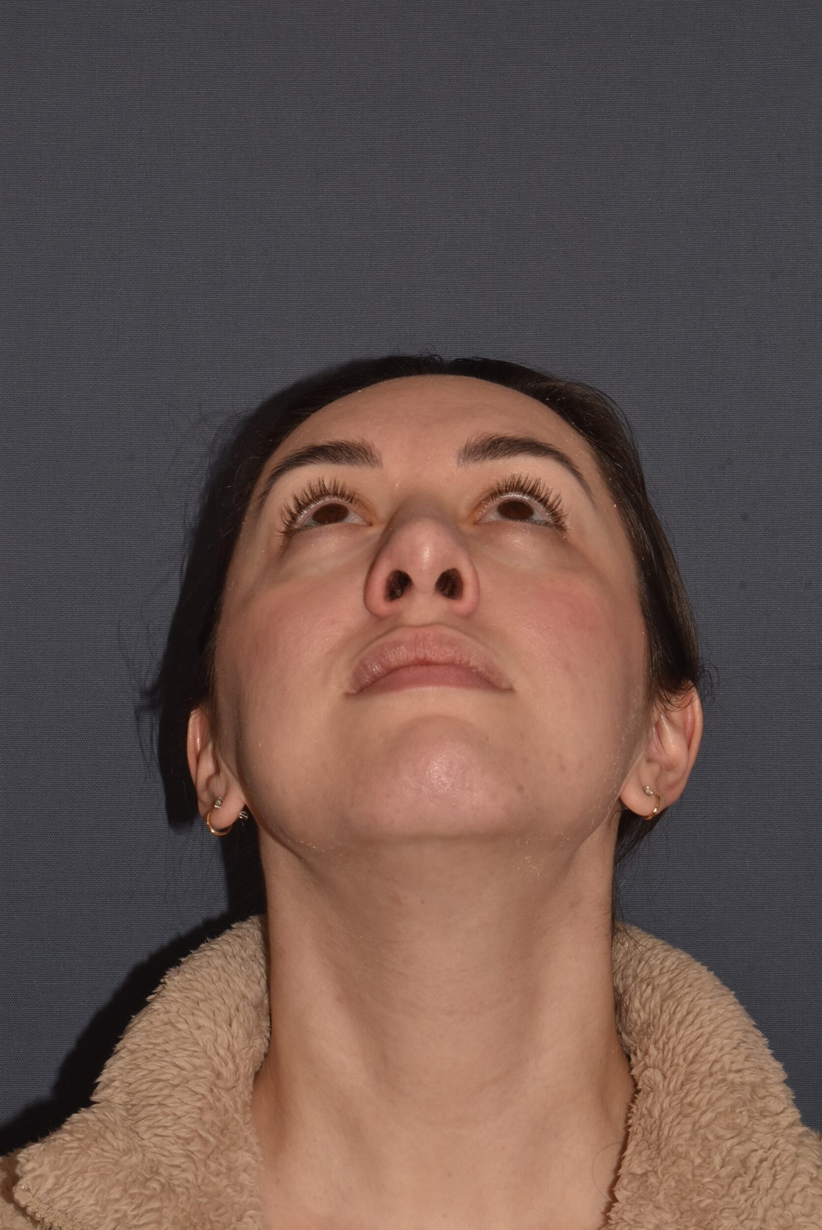 After Image: Rhinoplasty – Open - other