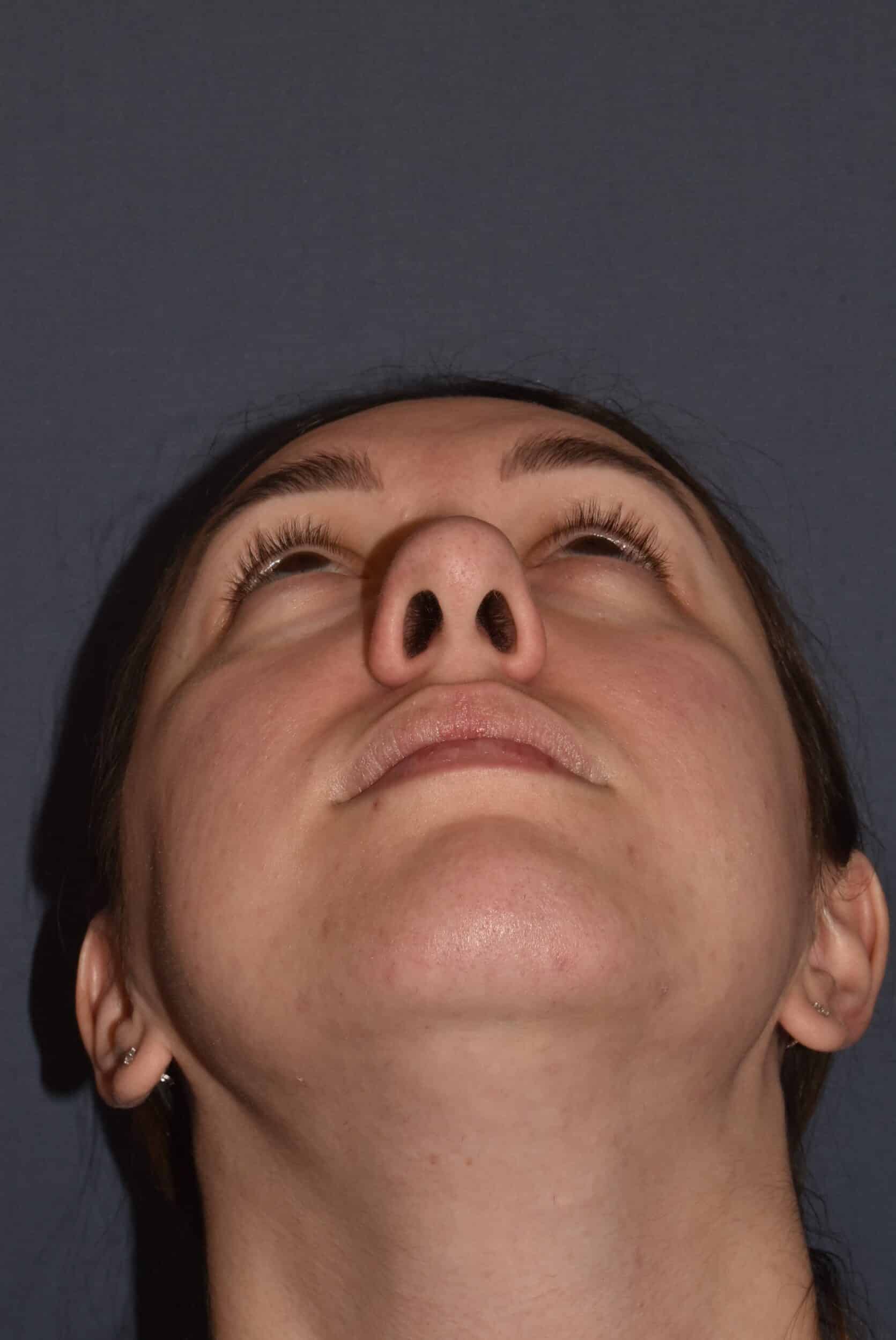 Before Image: Rhinoplasty – Open - other
