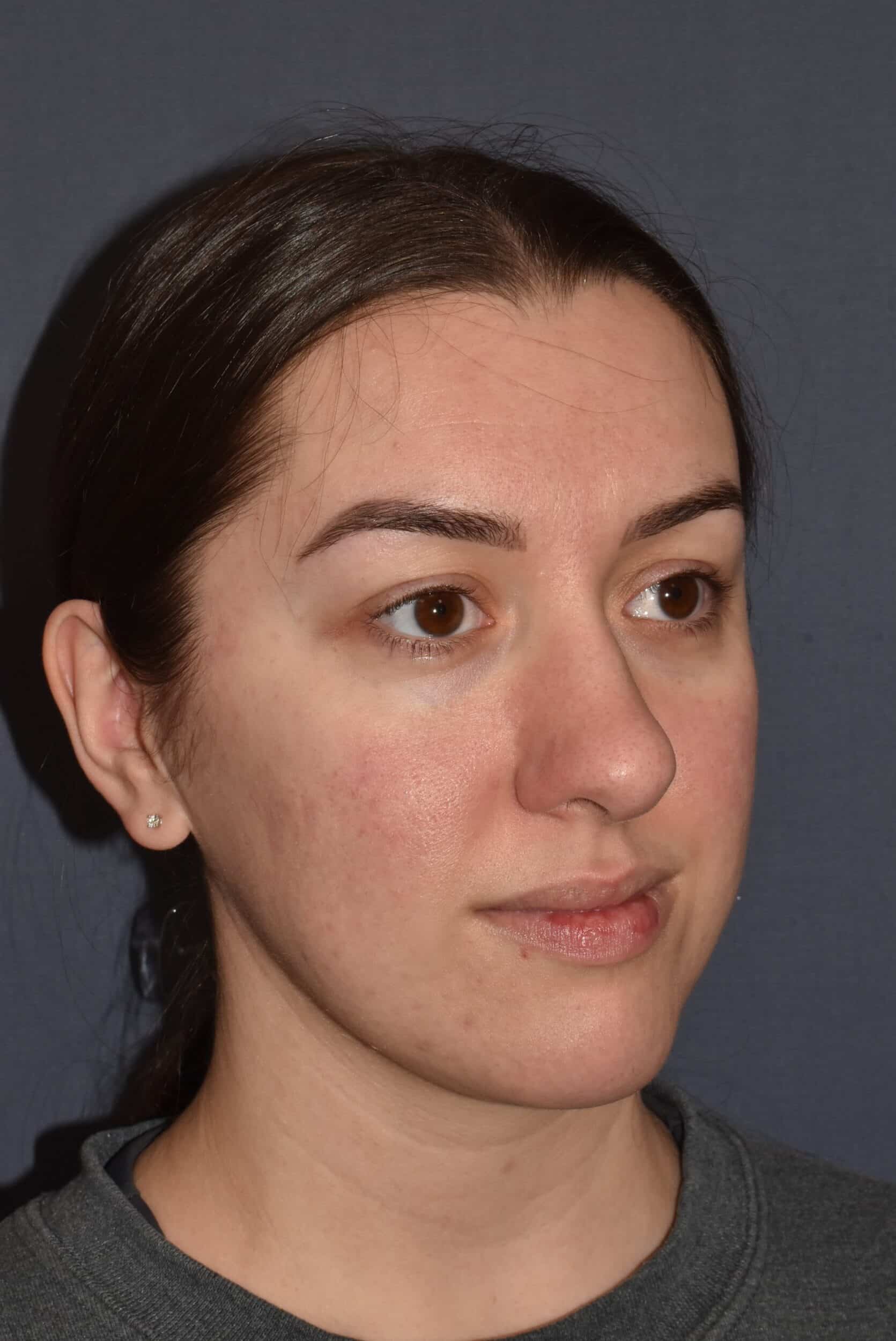 Before Image: Rhinoplasty – Open - right-front-oblique