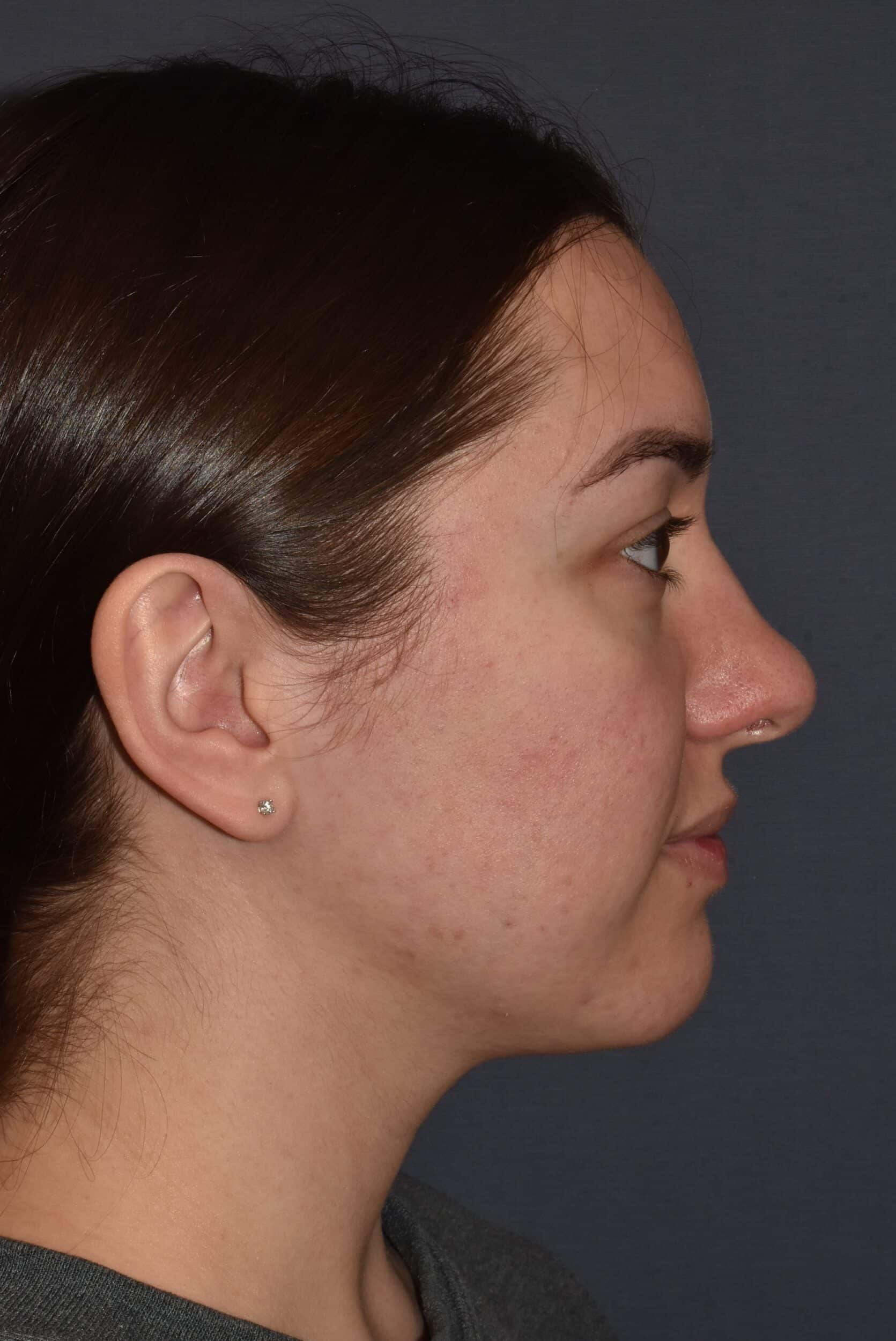 Before Image: Rhinoplasty – Open - right-side