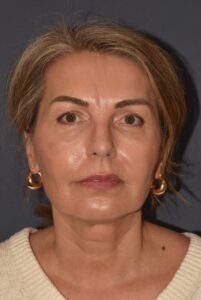 After Image: Rhinoplasty – Open