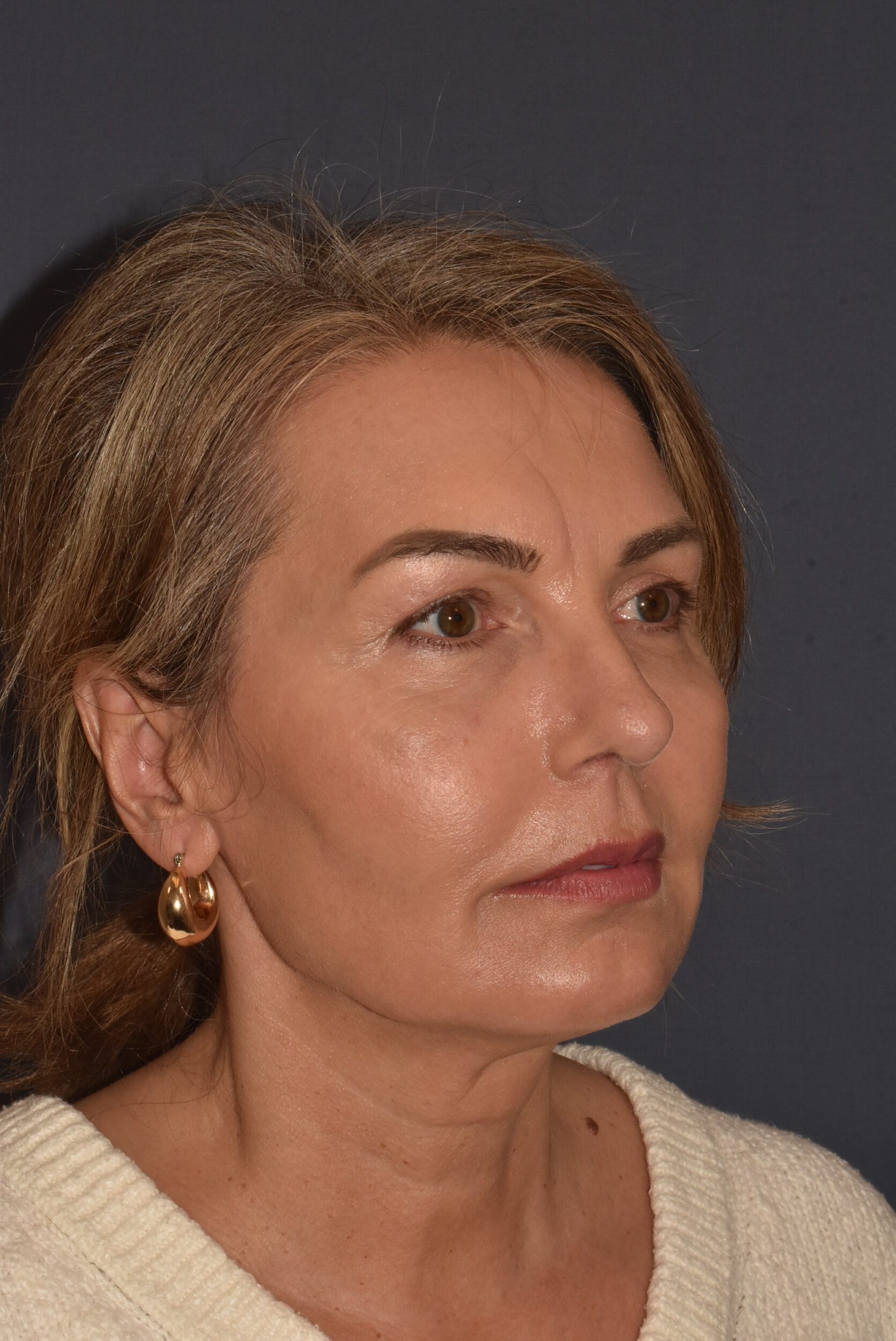 After Image: Rhinoplasty – Open - right-front-oblique