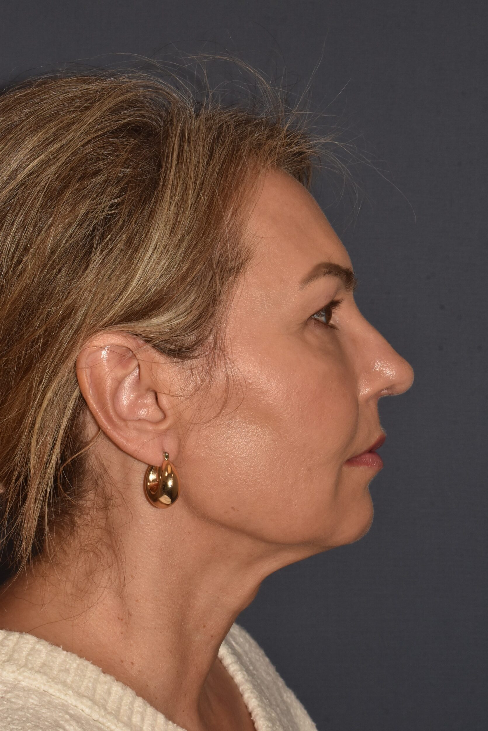 After Image: Rhinoplasty – Open - right-side