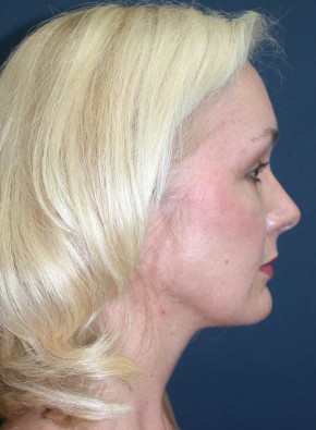 After Image: Facial Rejuvenation – Endoscopic Browlift and Upper Blepharoplasty - other