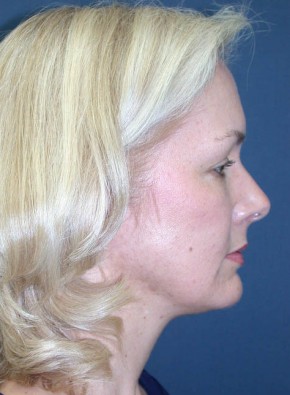 Before Image: Facial Rejuvenation – Endoscopic Browlift and Upper Blepharoplasty - other