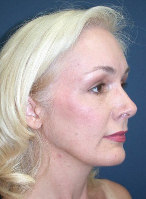 After Image: Facial Rejuvenation – Endoscopic Browlift and Upper Blepharoplasty - other