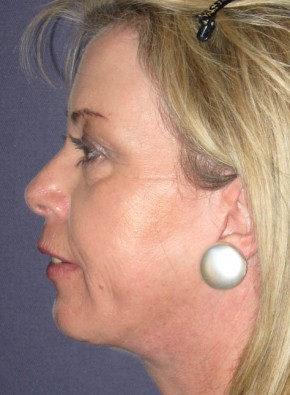 After Image: Facial Rejuvenation – Facelift, Browlift, and Chin Implant - other